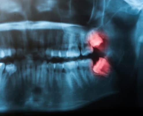 Wisdom Teeth Wisdom Teeth