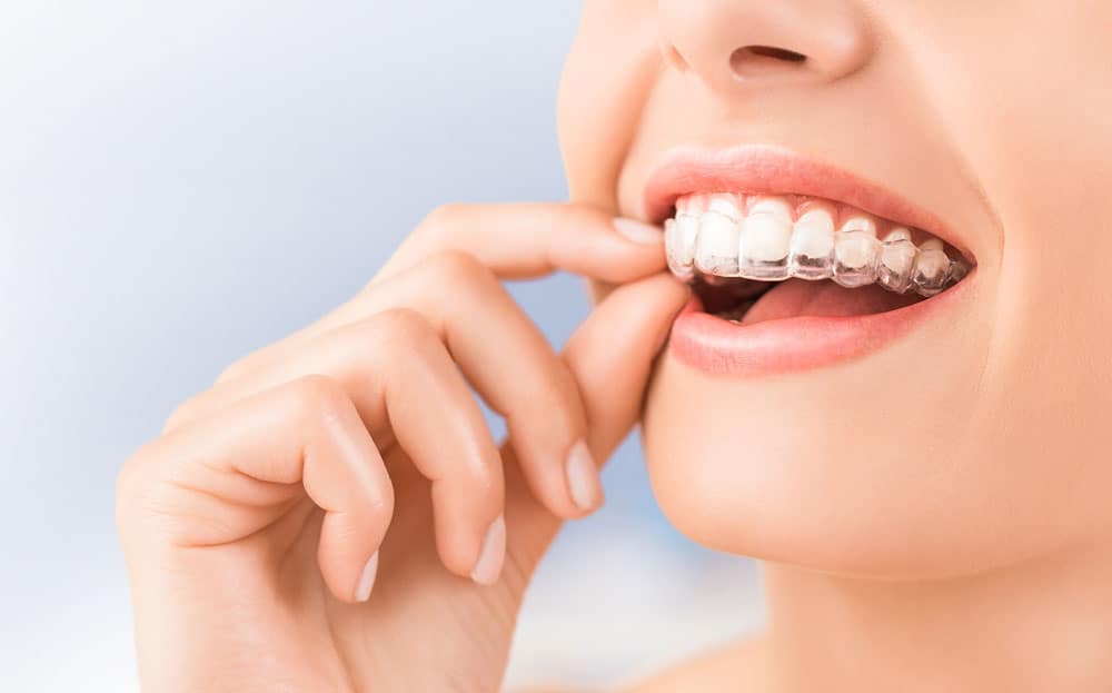 adult-invisalign-braces
