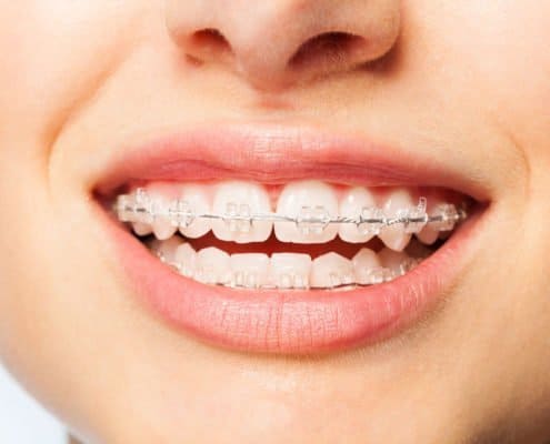 clear-braces clear-braces