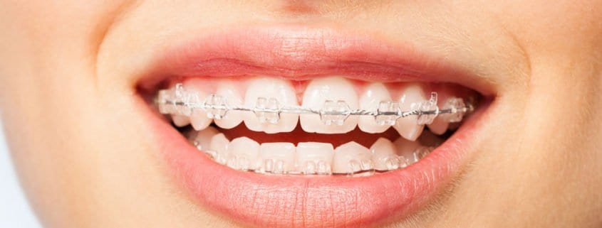 clear-braces