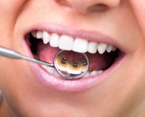 lingual-braces lingual-braces