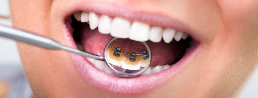 lingual-braces