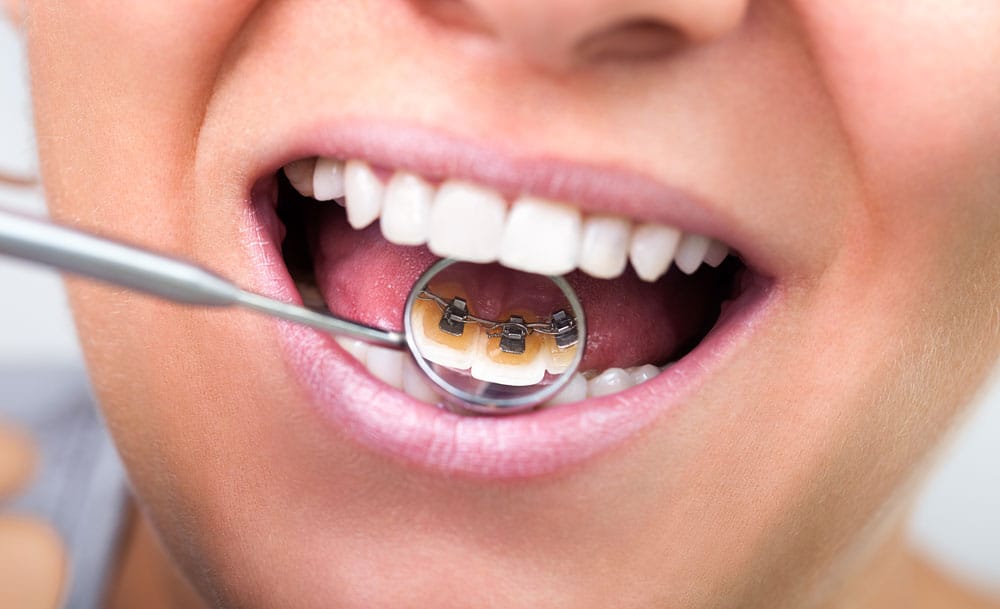 lingual-braces lingual-braces