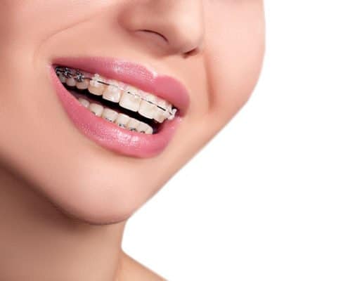 self-ligating-braces self-ligating-braces