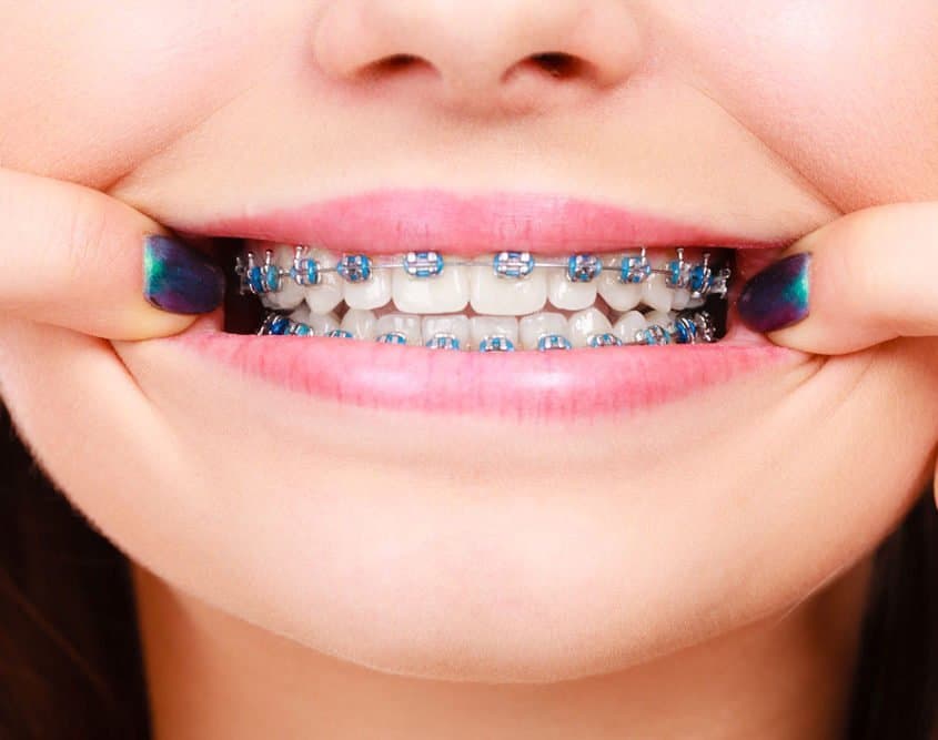 traditional-braces