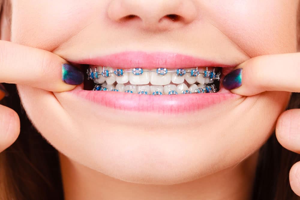 Braces Los Angeles, CA 90272 • Orthodontic Center LA