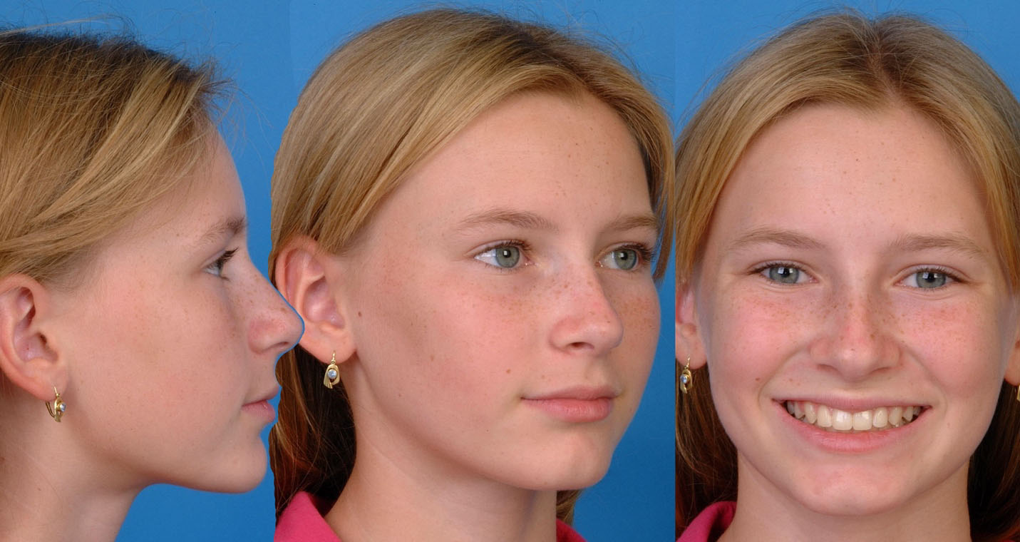 Orthodontic Center LA patient profiles