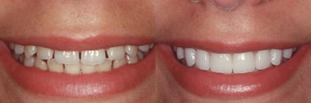 Before and After - Invisalign treatment