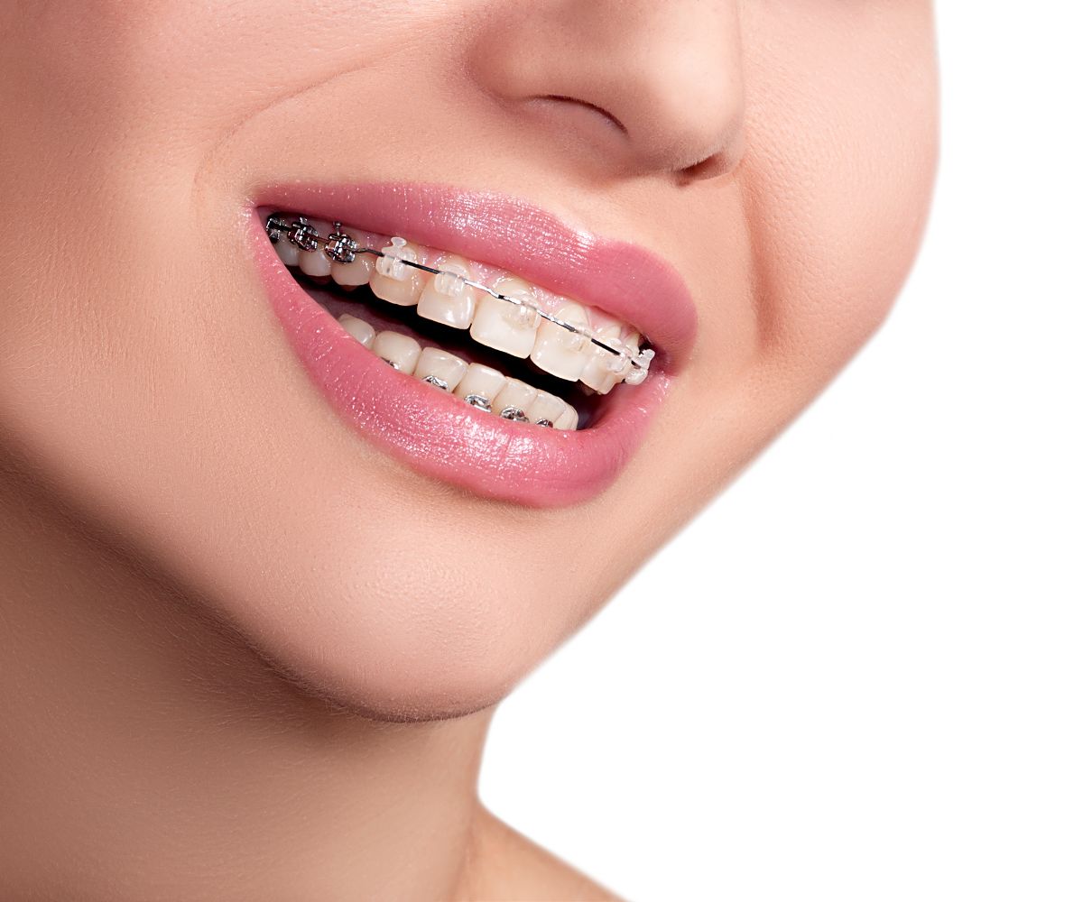 detail of a woman's mouth wearing braces