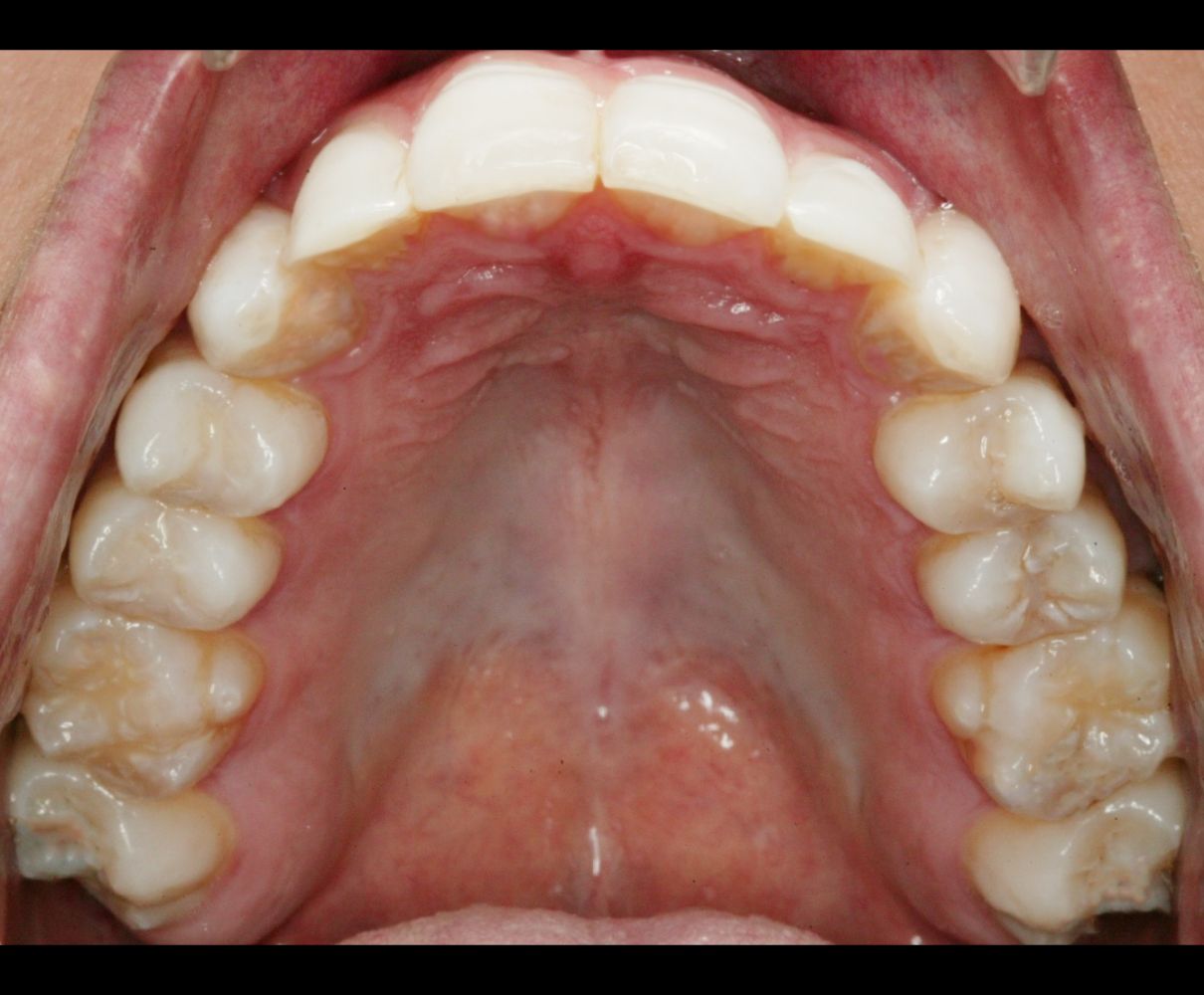 After orthodontic treatment